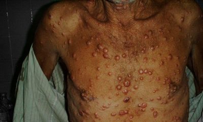 Lepra en 18 estados de México
